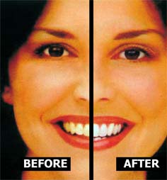 Teeth whitening - before and after